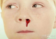 流鼻血是什么原因,探寻身体发出的警示信号